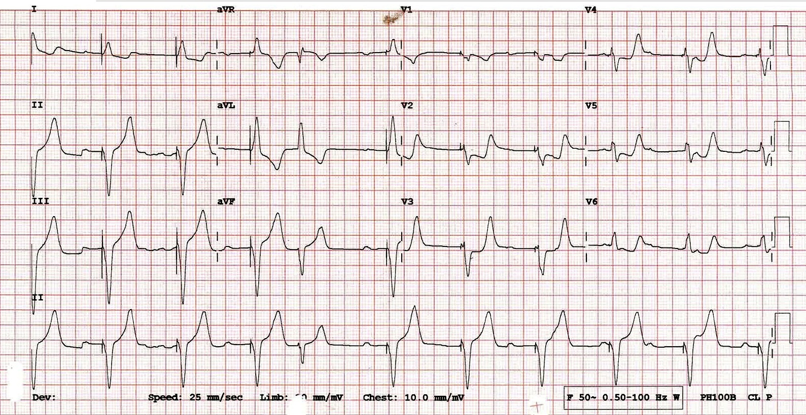 17-Sgarbossa-criteria : Emergency Care BC